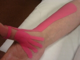 Kineziotaping